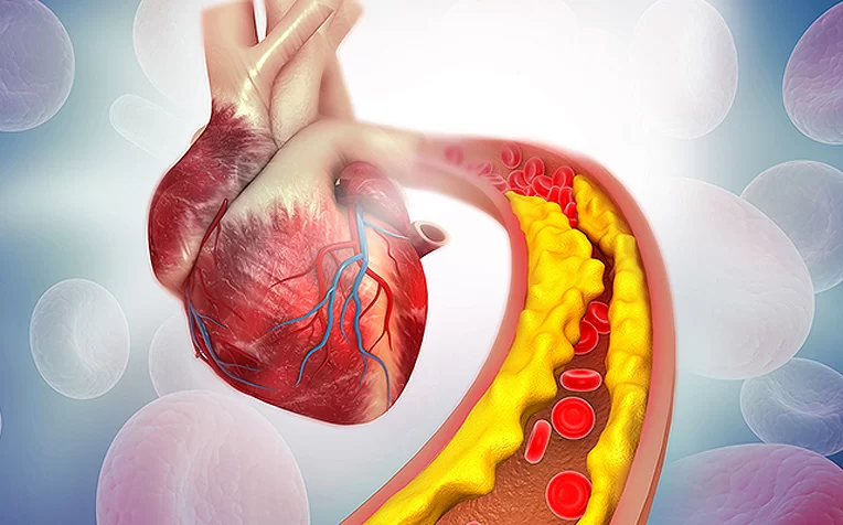 The Vital Role of a Heart Specialist in Managing Atherosclerosis and Preventing Heart Disease