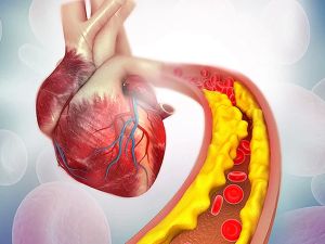 The Vital Role of a Heart Specialist in Managing Atherosclerosis and Preventing Heart Disease