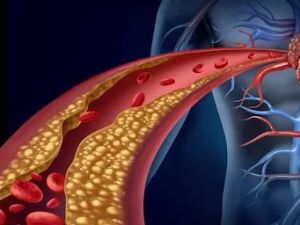 The Truth About Cholesterol and Heart Disease: What You Need to Know