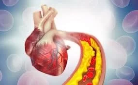 How High Cholesterol Contributes to Heart Disease: Key Insights