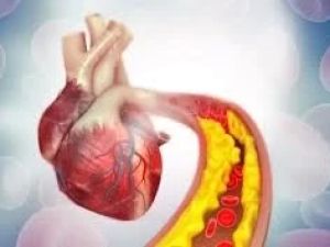 How High Cholesterol Contributes to Heart Disease: Key Insights