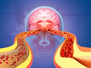 Understanding the Difference Between Heart Attack and Stroke: Key Facts You Need to Know