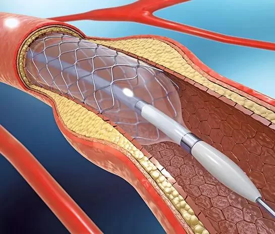 How Cardiologists Use Cardiac Catheterization to Diagnose Heart Disease