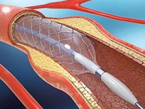 How Cardiologists Use Cardiac Catheterization to Diagnose Heart Disease