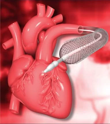 How Cardiologists Use Angioplasty to Treat Blocked Arteries and Improve Heart Health