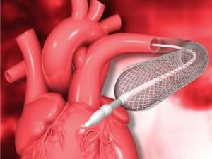 How Cardiologists Use Angioplasty to Treat Blocked Arteries and Improve Heart Health