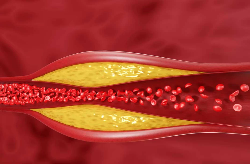 The Truth About High Cholesterol and Heart Disease: Understanding the Risks and Prevention