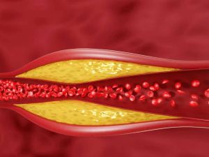 The Truth About High Cholesterol and Heart Disease: Understanding the Risks and Prevention