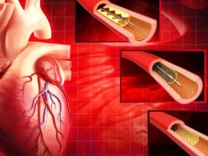 How Cardiologists Use Cardiac Catheterization for Heart Disease Diagnosis