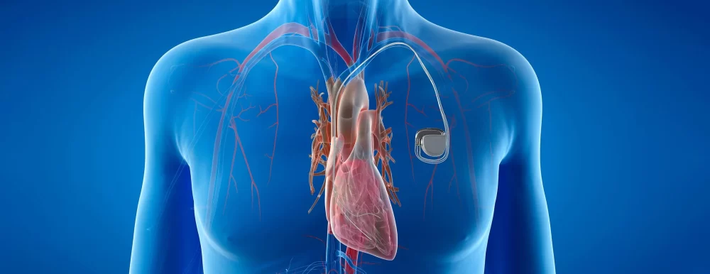 How to Find the Best Cardiologist Specializing in Pacemaker Surgeries