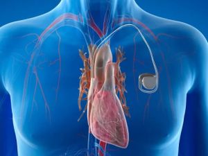How to Find the Best Cardiologist Specializing in Pacemaker Surgeries