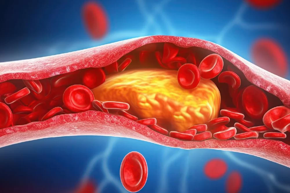 How to Recognize Early Symptoms of High Cholesterol Before It’s Too Late