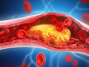 How to Recognize Early Symptoms of High Cholesterol Before It’s Too Late