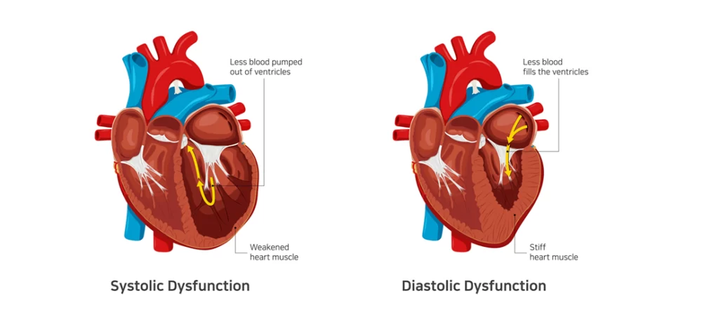 Heart Failure in Humans: Symptoms and Diagnosis You Shouldn’t Ignore