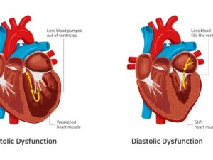 Heart Failure in Humans: Symptoms and Diagnosis You Shouldn’t Ignore
