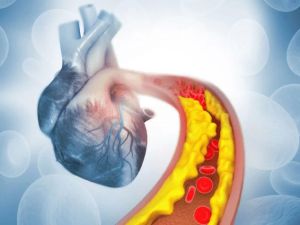 The Connection Between Heart Disease and High Cholesterol – Understanding the Link