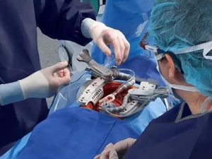 How to Choose the Right Heart Surgeon for Bypass Surgery