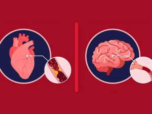 Understanding the Symptoms of Stroke and Heart Disease