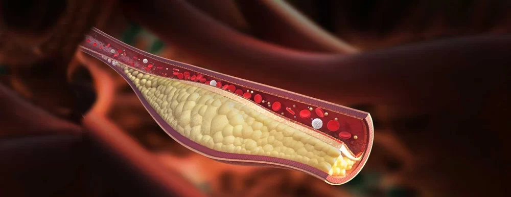 The Connection Between High Cholesterol and Heart Disease Prevention: What You Need to Know
