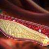 The Connection Between High Cholesterol and Heart Disease Prevention: What You Need to Know