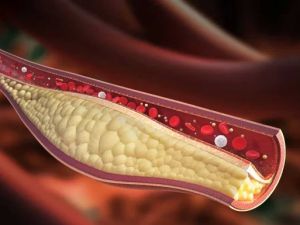 The Connection Between High Cholesterol and Heart Disease Prevention: What You Need to Know