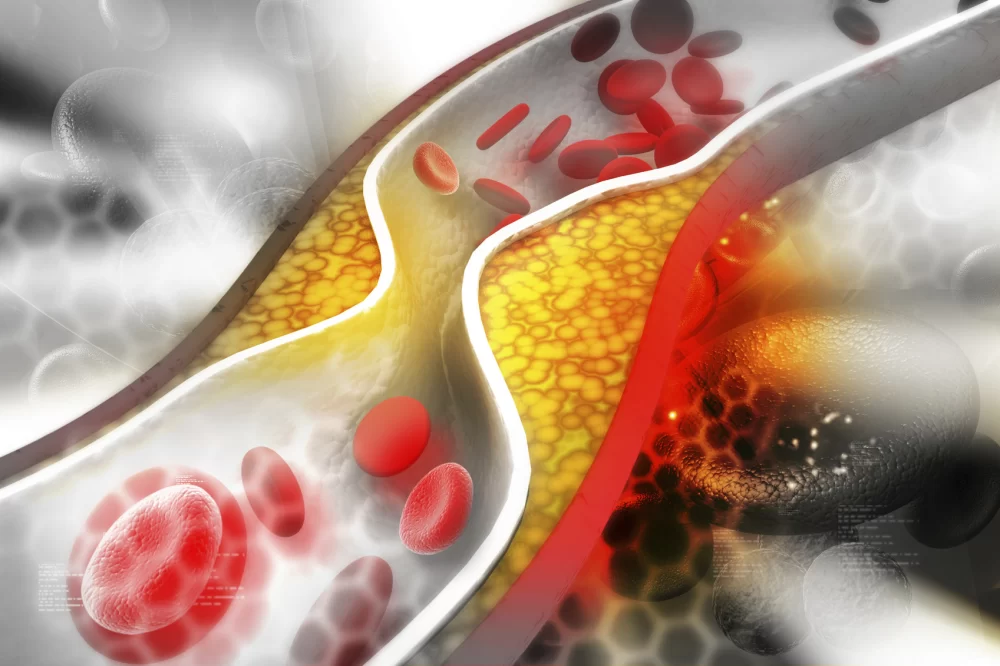 How to Lower Your Cholesterol and Reduce Heart Disease Risk