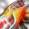 How to Lower Your Cholesterol and Reduce Heart Disease Risk