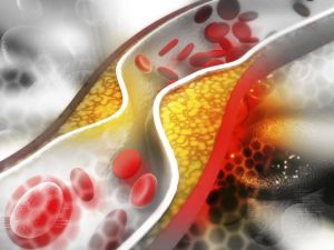 How to Lower Your Cholesterol and Reduce Heart Disease Risk