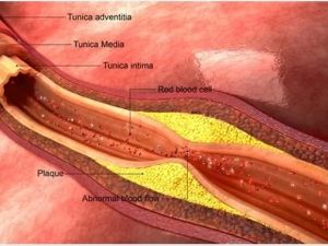 How High Cholesterol Leads to Heart Disease and What You Can Do About It