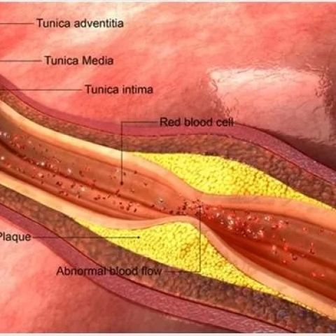 How High Cholesterol Leads to Heart Disease and What You Can Do About It