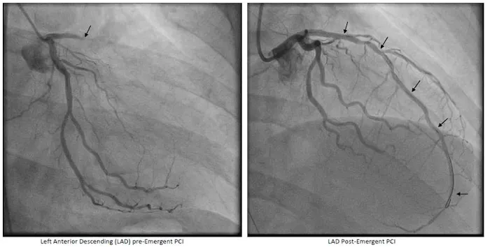 Anderson Hospital Chest Pain Center 2