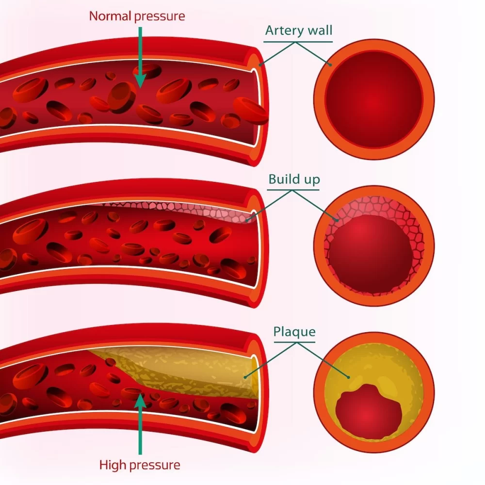 How High Blood Pressure Contributes to Heart Disease