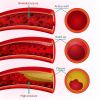 How High Blood Pressure Contributes to Heart Disease