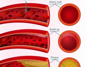 How High Blood Pressure Contributes to Heart Disease
