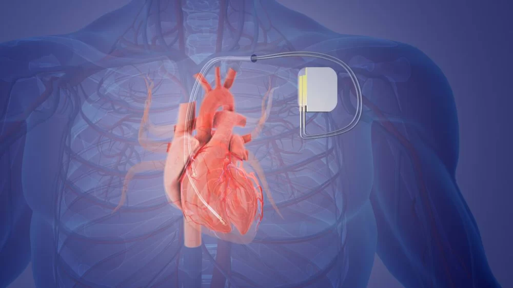 Understanding Heart Disease and Pacemaker Use for Effective Heart Rhythm Management