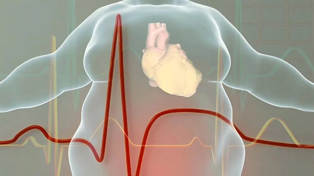 The Growing Concern of Obesity and Its Impact on Heart Disease