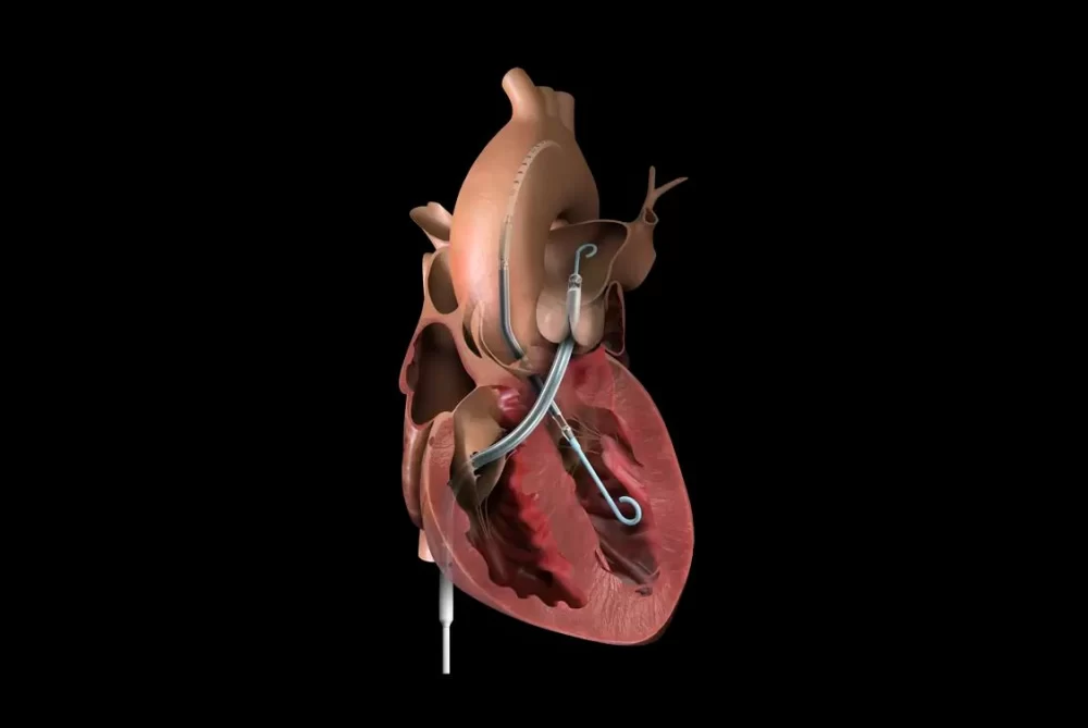 Exploring Effective Treatment Options for Heart Failure