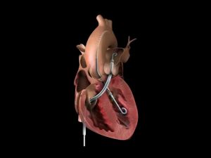 Exploring Effective Treatment Options for Heart Failure