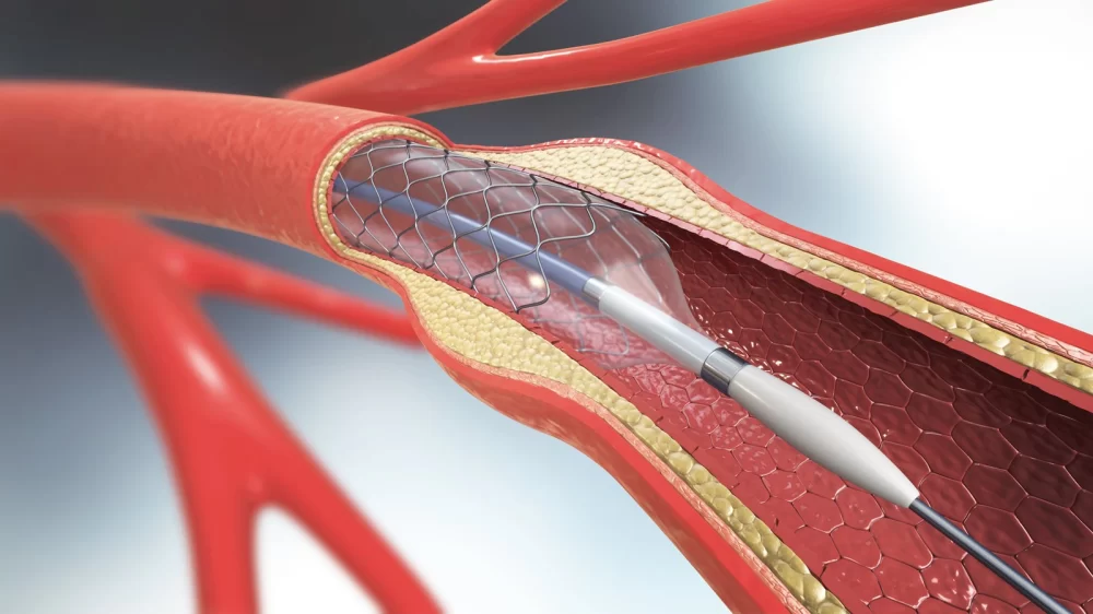 Understanding Implantable Defibrillators and Their Role in Heart Disease Management