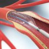 Understanding Implantable Defibrillators and Their Role in Heart Disease Management
