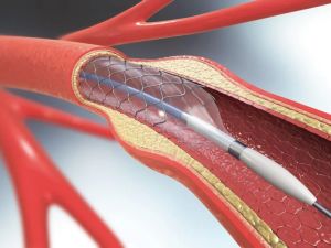 Understanding Implantable Defibrillators and Their Role in Heart Disease Management