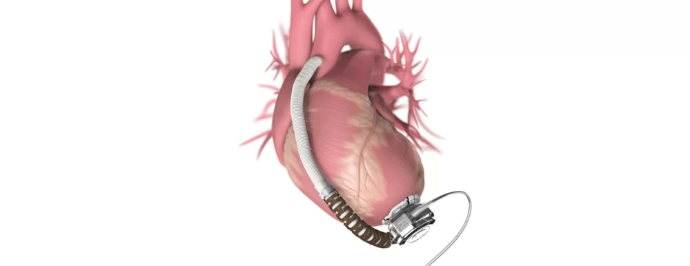 Exploring Ventricular Assist Devices as a Vital Option for Heart Disease Management