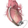 Exploring Ventricular Assist Devices as a Vital Option for Heart Disease Management