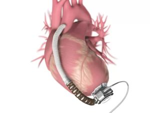 Exploring Ventricular Assist Devices as a Vital Option for Heart Disease Management