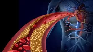 The Critical Role of Vascular Inflammation in Heart Disease Development