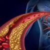 The Critical Role of Vascular Inflammation in Heart Disease Development
