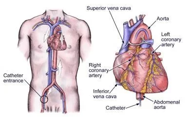 Understanding the Cardiac Catheterization Procedure: A Clear Explanation