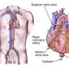 Understanding the Cardiac Catheterization Procedure: A Clear Explanation