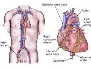 Understanding the Cardiac Catheterization Procedure: A Clear Explanation