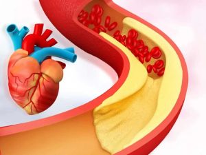 Effective Heart Disease Management Using Reliable Cholesterol Meters for Better Heart Health